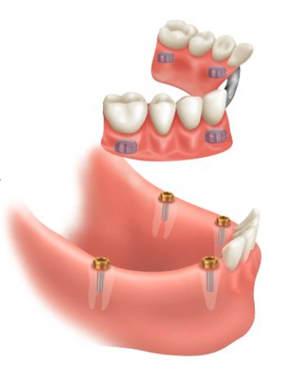 ROOT LOCATOR® 20 GRADER